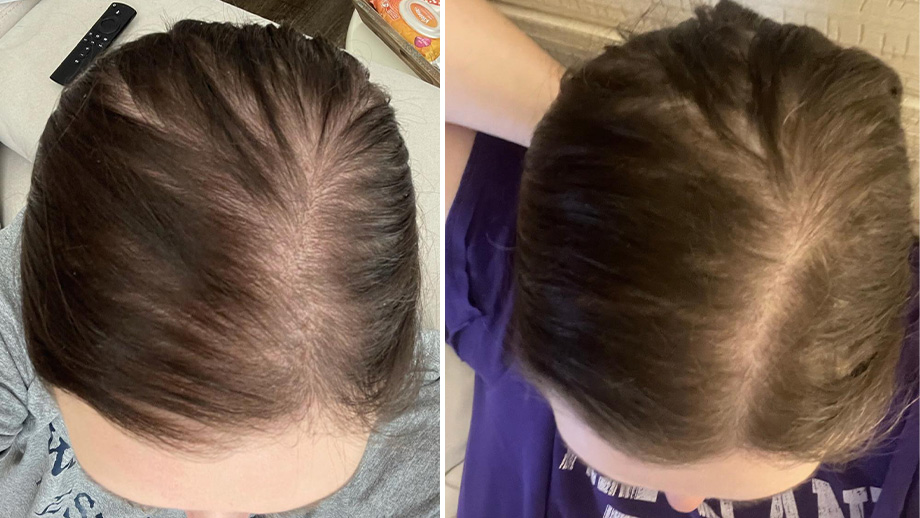 PCOS Hair Thinning Example